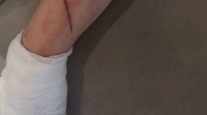 Желание погладить котика обернулось для 5-летнего ребёнка операцией на руке у малышки началось гноен