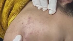 Удаление множества скрытых прыщей: полная чистка