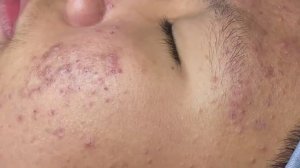 166 • Acne collection • АСМР • Relax Spa