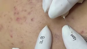 #56 Удаление прыщей. Экстрация комедонов. Подкожные прыщи. Чистка от черных точек