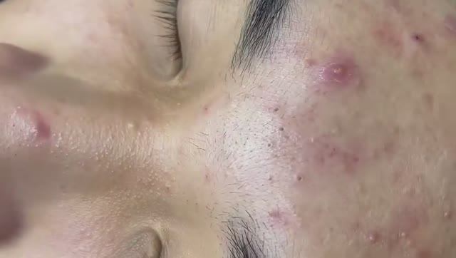 169 • Acne collection • АСМР • Relax Spa смотреть онлайн