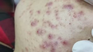 #67 Удаление прыщей. Экстрация комедонов. Подкожные прыщи. Чистка от черных точек
