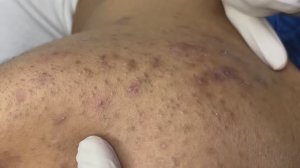 Экстракция комедонов и прыщей