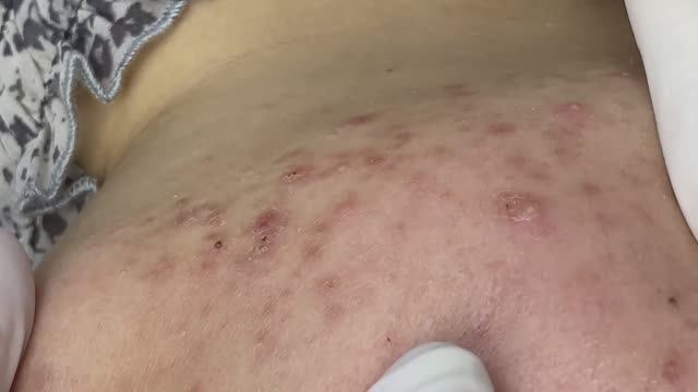 Удаление черных точек и акне за 14 минут