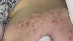 Удаление черных точек и акне за 14 минут