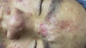 165 • Acne collection • АСМР • Relax Spa