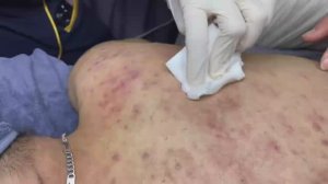 167 • Acne collection • АСМР • Relax Spa