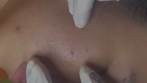ASMR чистка лица от подкожных прыщей и черных точек