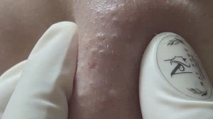 Из пор вылетело всё, что копилось годами 😱