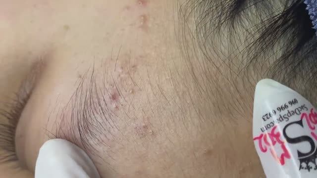 173 • Acne collection • АСМР • Relax Spa смотреть онлайн