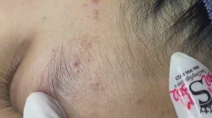 173 • Acne collection • АСМР • Relax Spa