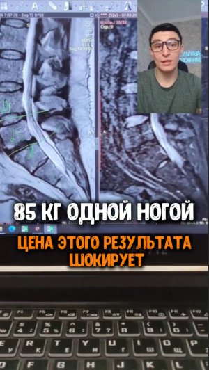 85 кг одной ногой. #здоровье #спина #реабилитация #фитнес #упражнения #больвспине #здоровьеспины