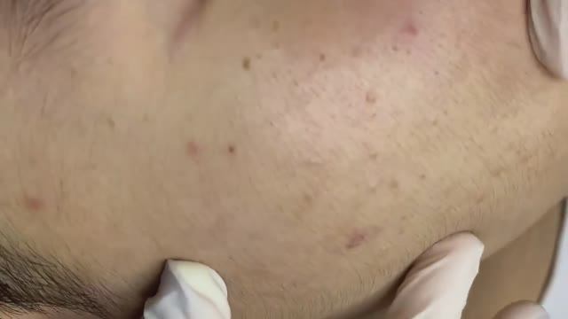 177 • Acne collection • АСМР • Relax Spa смотреть онлайн