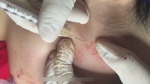 Чистка лица от прыщей и черных точек