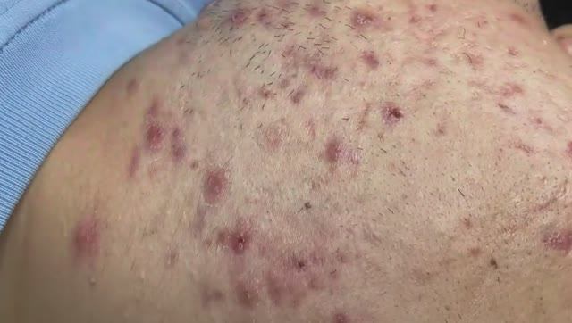 174 • Acne collection • АСМР • Relax Spa смотреть онлайн