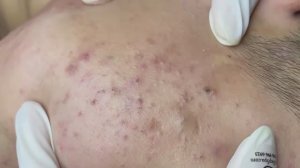 176 • Acne collection • АСМР • Relax Spa