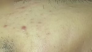 #83 Удаление прыщей. Экстрация комедонов. Подкожные прыщи. Чистка от черных точек