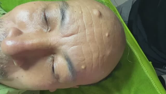 Удаление прыщей и черных точек для релакса