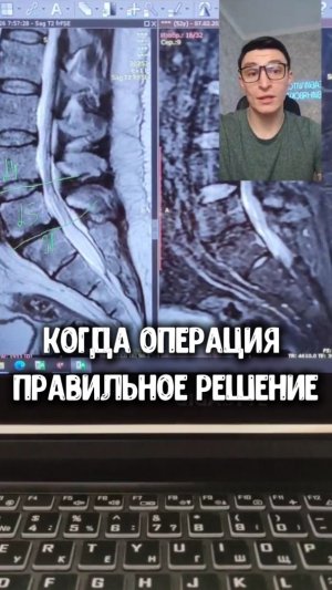 Грыжа L5-S1: когда операция неизбежна? #грыжапозвоночника #операциянапозвоночник #больвспине