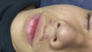179 • Acne collection • АСМР • Relax Spa