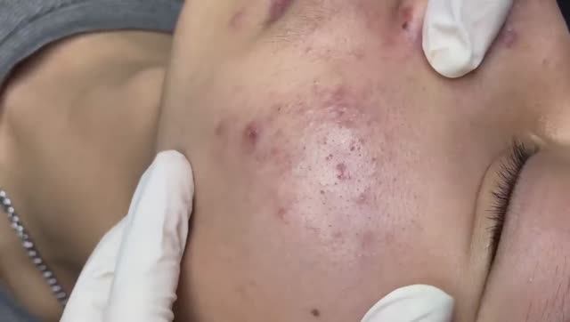 178 • Acne collection • АСМР • Relax Spa смотреть онлайн