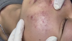 178 • Acne collection • АСМР • Relax Spa