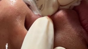 Экстракция комедонов, прыщей и черных точек: как это работает