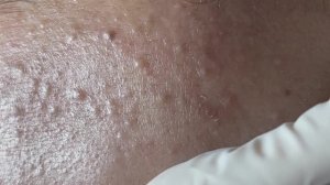Чистка лица от подкожных прыщей и черных точек
