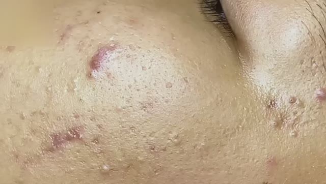 #100 Удаление прыщей. Экстрация комедонов. Подкожные прыщи. Чистка от черных точек