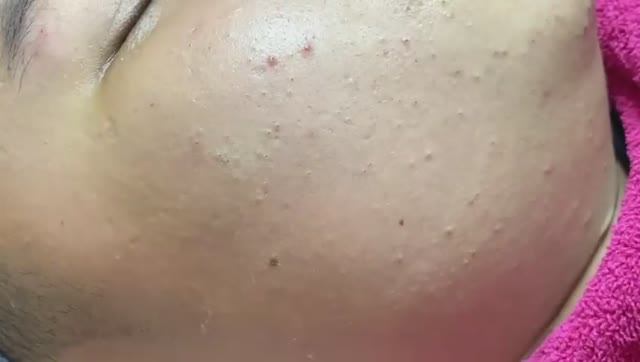 Чистка кожи от подкожных прыщей и черных точек