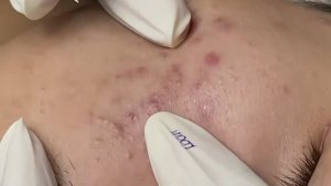 Глубокле очищение кожи от прыщей, акне и черных точек