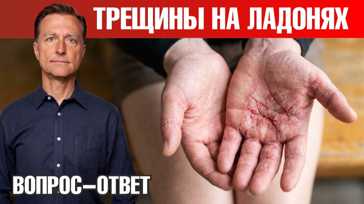 Экзема на ладонях: почему кожа не заживает и что делать?