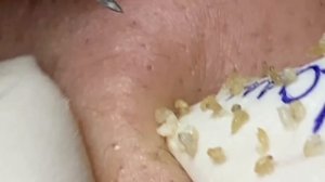Экстракция комедонов, прыщей и черных точек
