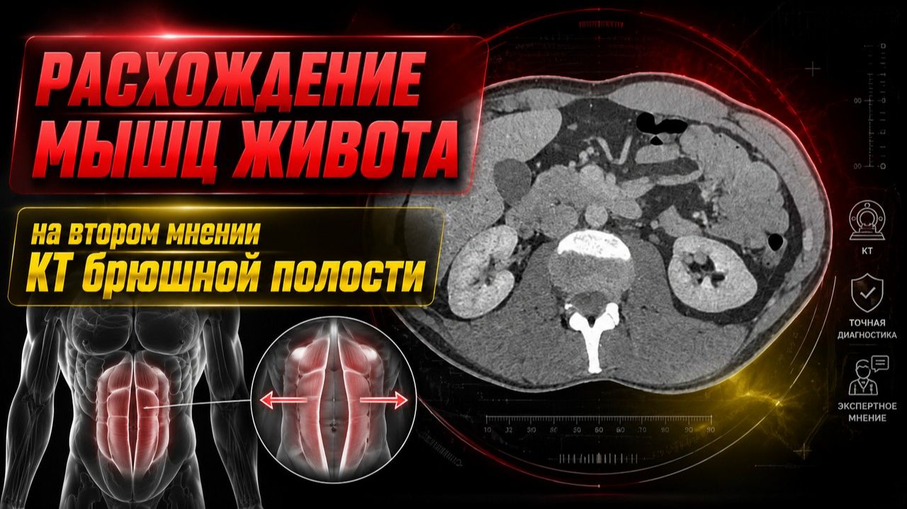 ДИАСТАЗ живота (РАСХОЖДЕНИЕ ПРЯМОЙ МЫШЦЫ живота) и гепатомегалия на РАСШИФРОВКЕ КТ брюшной полости