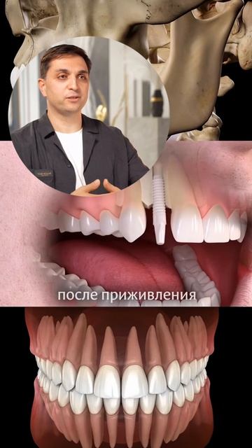 Как проходит имплантация, если вы потеряли зуб