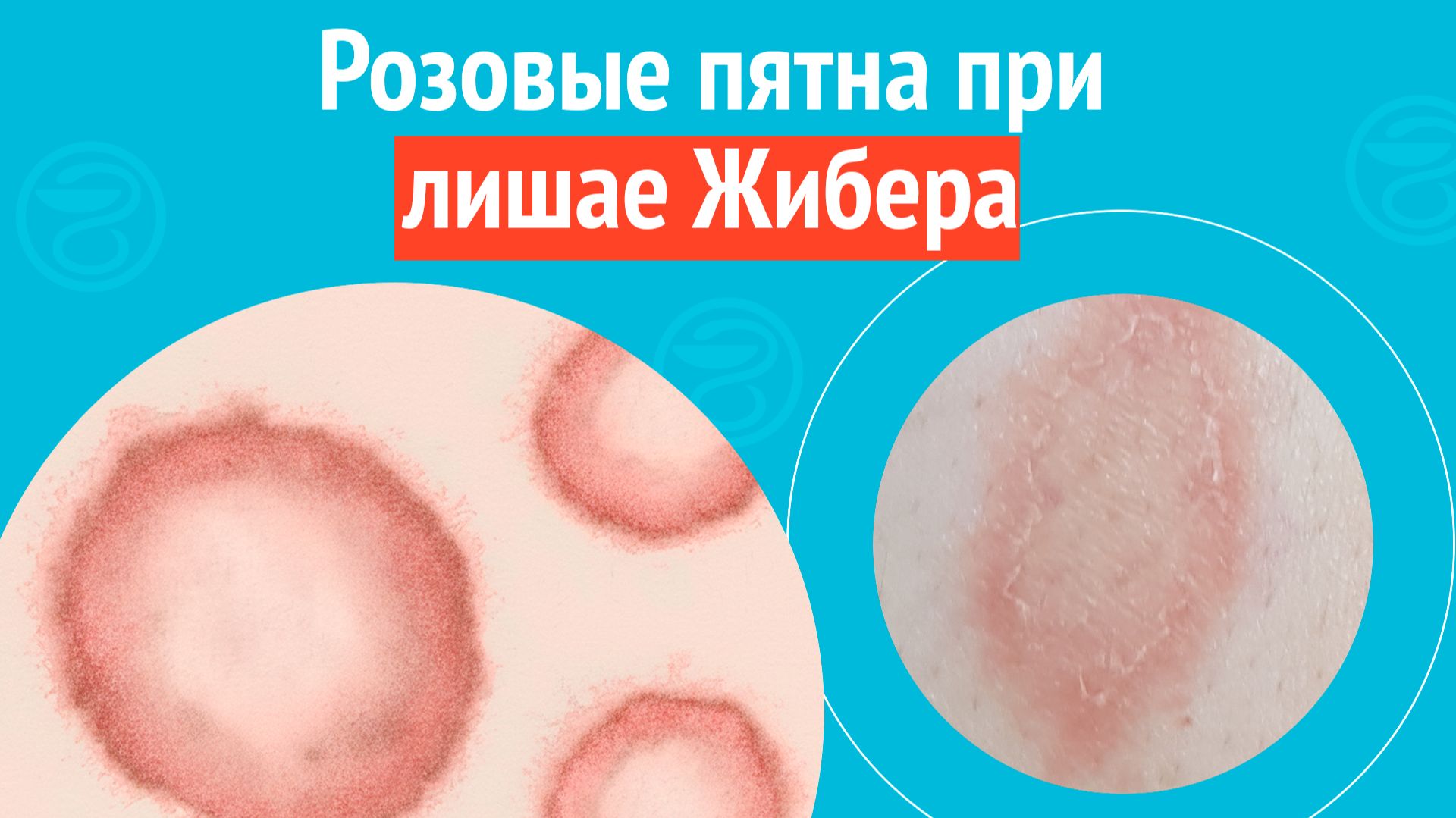 😢 Розовые пятна при лишае Жибера. Клинический случай № 1796 смотреть онлайн