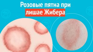 😢 Розовые пятна при лишае Жибера. Клинический случай № 1796