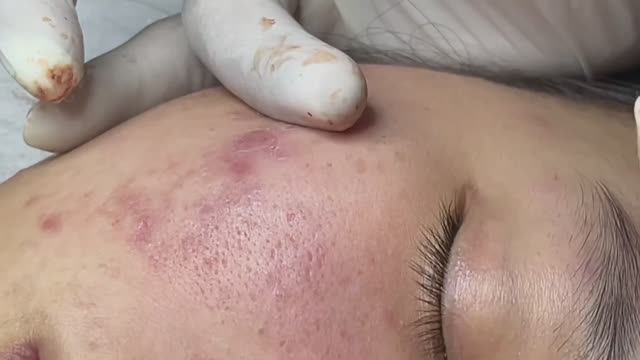 Санация проблемной кожи от всего лишнего смотреть онлайн