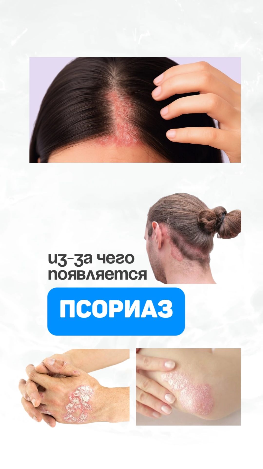 Из-за чего появляется псориаз? Семейный доктор Алена Братишко