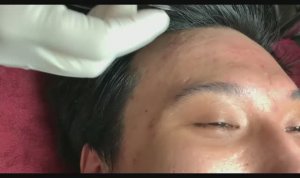 Глубокая чистка лица: Удаление Acne.