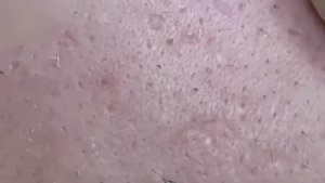 #101 Удаление прыщей. Экстрация комедонов. Подкожные прыщи. Чистка от черных точек