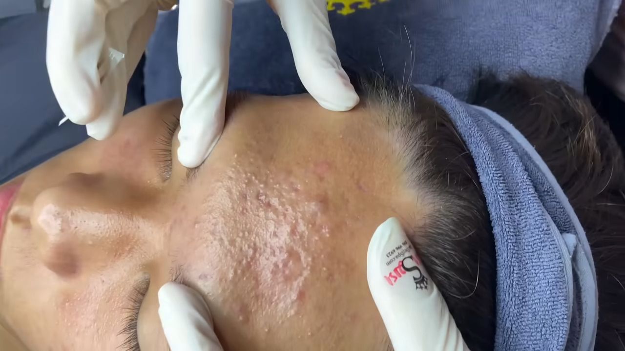 187 • Acne collection • АСМР • Relax Spa смотреть онлайн