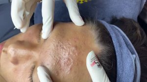 187 • Acne collection • АСМР • Relax Spa