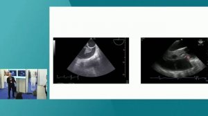 TRANSESOPHAGEAL LUNG ULTRASONOGRAPHY ISICEM 45