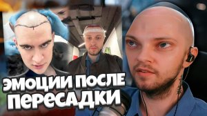 ЭМОЦИИ СТИНТА и БРАТИШКИНА ПОСЛЕ ПЕРЕСАДКИ ВОЛОС / ПОСЛЕДСТВИЯ ПЕРЕСАДКИ? ЗАПРЕТЫ?