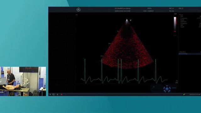 DOPPLER-BASED MEASUREMENTS TO IDENTIFY VENOUS CONGESTION ISICEM 45 смотреть онлайн