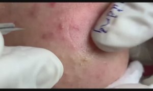 Asmr. Очищение лица от подкожных угрей.
