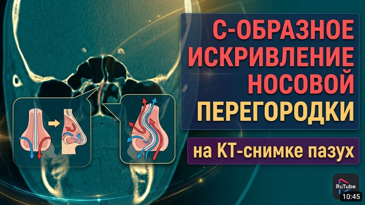 S образное ИСКРИВЛЕНИЕ перегородки носа и ВАЗОМОТОРНЫЙ РИНИТ на РАСШИФРОВКЕ КТ околоносовых пазух