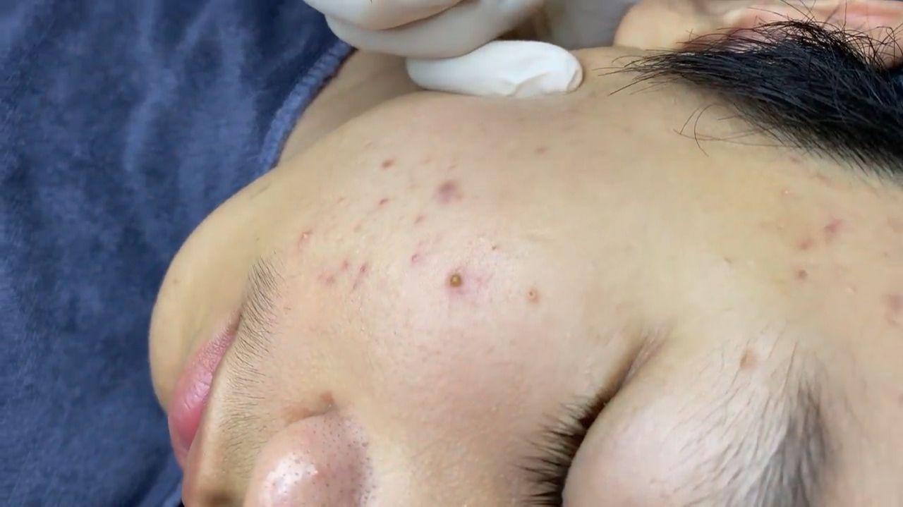 175 • Acne collection • АСМР • Relax Spa смотреть онлайн