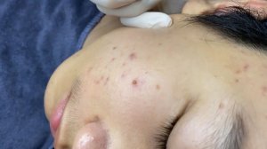 175 • Acne collection • АСМР • Relax Spa